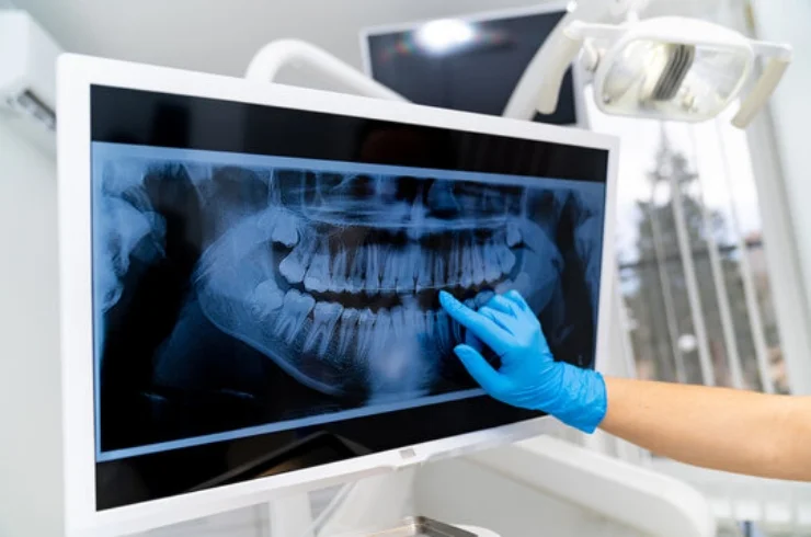 Dental X-Ray------16